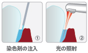 耐性菌にも効く